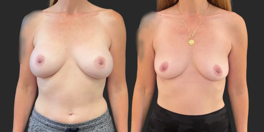 Breast Implant Removal #013, before and after photo