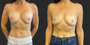 Bilateral Implant Removal #014, before and after photo