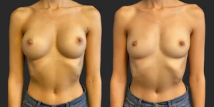 Bilateral Implant Removal #015, before and after photo