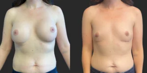 Implant Removal #016, before and after photo, view 2