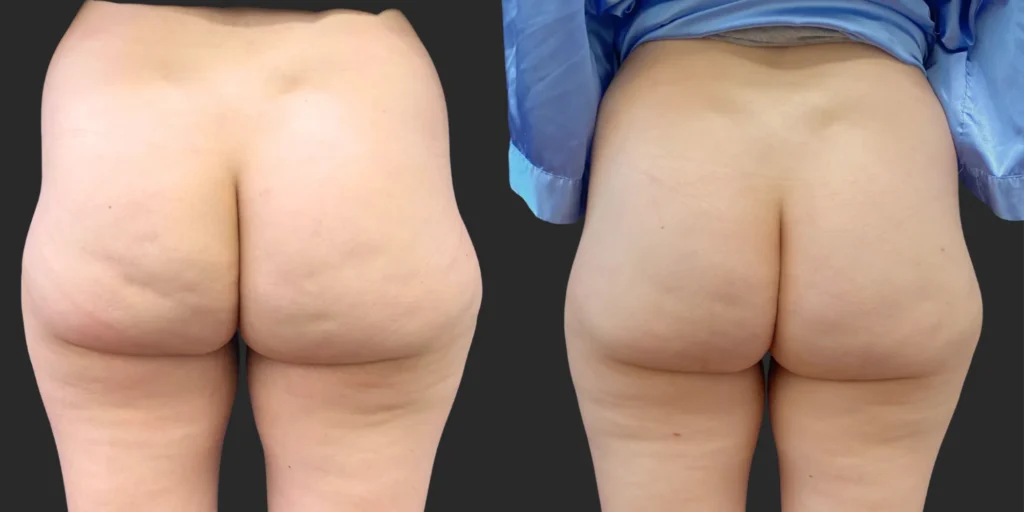 Avéli Cellulite Reduction #004, before and after photo