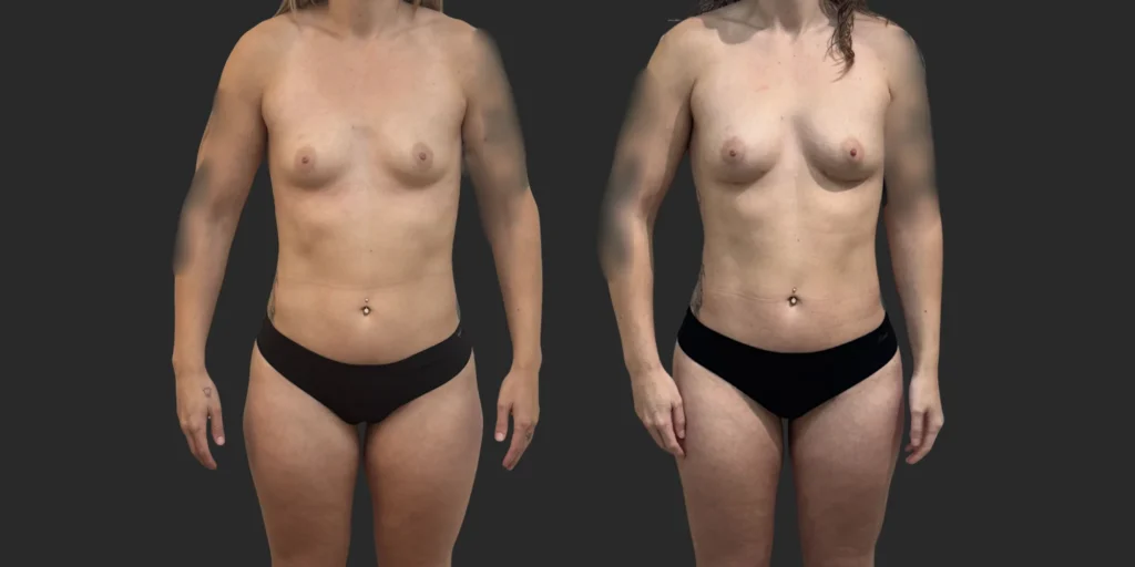 Lipo of Inner/Outer Thighs + Knees with Fat Transfer to Breasts #034, before and after photo