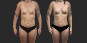 Lipo of Inner/Outer Thighs + Knees with Fat Transfer to Breasts #034, before and after photo