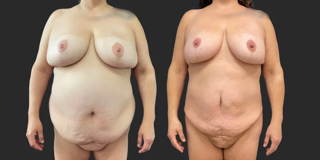 Lipo of Upper/Lower Abdomen, Pubis, Front Bra Roll, Lateral Breasts #035, before and after photo