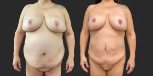 Lipo of Upper/Lower Abdomen, Pubis, Front Bra Roll, Lateral Breasts #035, before and after photo