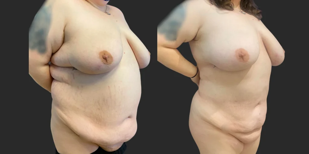 Lipo to Hips/Waist/Back Bra Roll with Fat Transfer to Buttocks #037, before and after photo
