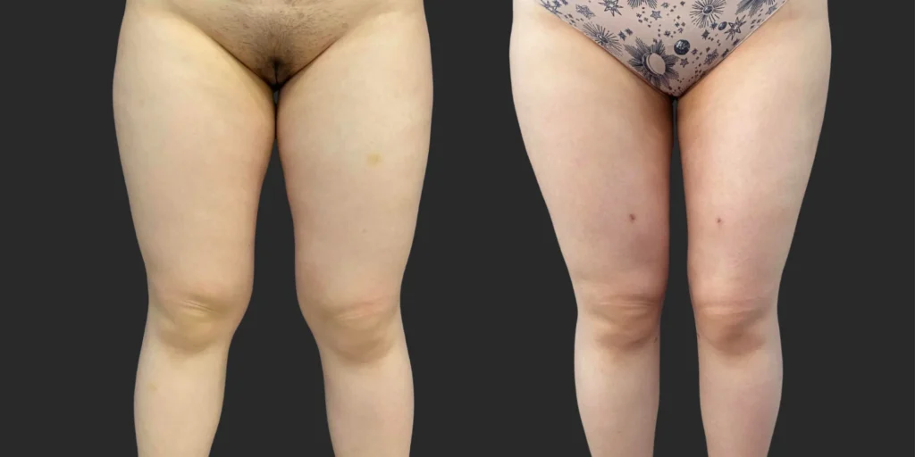 Lipo of Inner/Outer Thighs + Knees #039, before and after photo