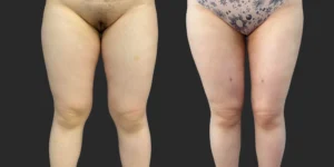 Lipo of Inner/Outer Thighs + Knees #039, before and after photo