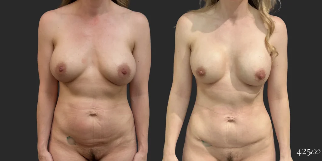 Pocket change and Mini Abdominoplasty #001, before and after photo
