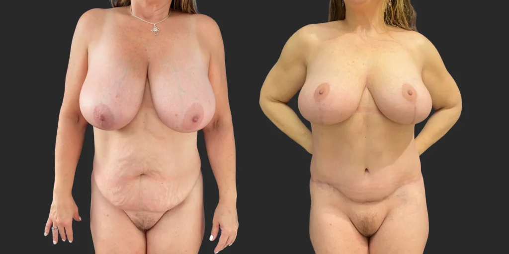 Bilateral Breast Reduction + Abdominoplasty #002, before and after photo
