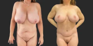 Bilateral Breast Reduction + Abdominoplasty #002, before and after photo