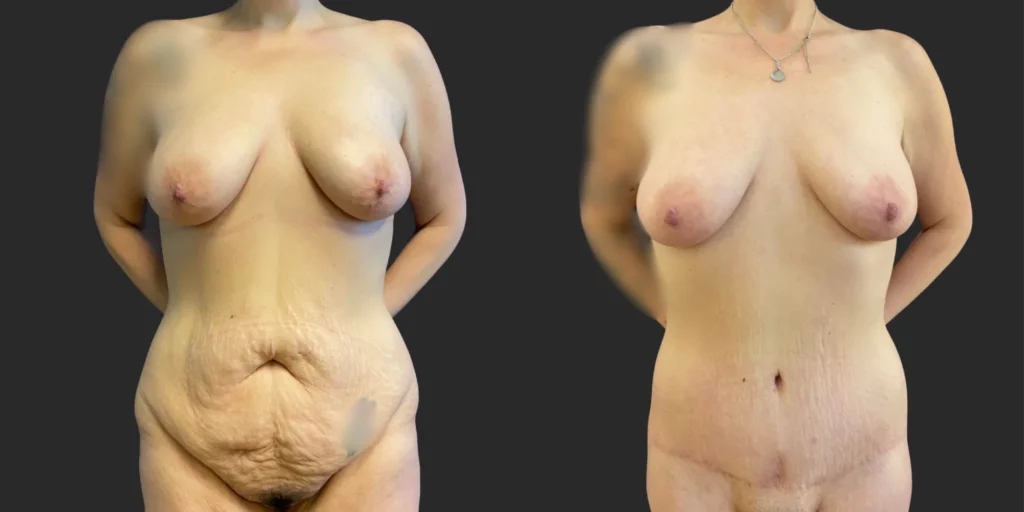 Abdominoplasty and Belt Lipectomy #003, before and after photo