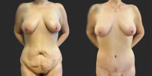 Abdominoplasty and Belt Lipectomy #003, before and after photo