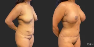 Abdominoplasty with Mastopexy and Breast Augmentation #004, before and after photo, view 2