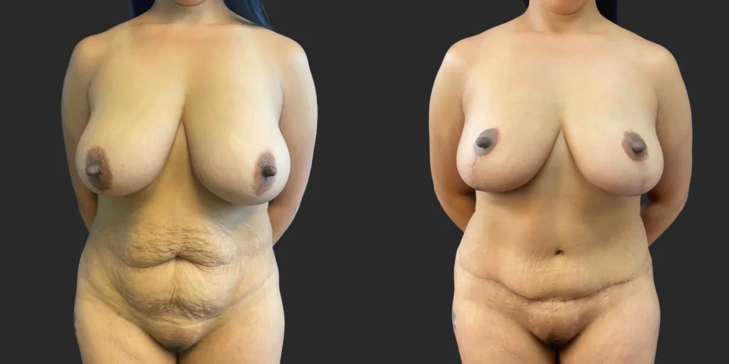 Abdominoplasty and Breast Reduction #005, before and after photo