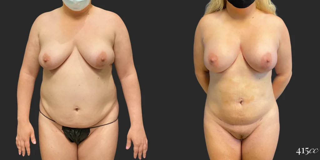 360 BBL plus Liposuction of Upper Arms and Breast Augmentation #034, before and after photo