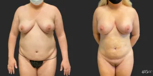 360 BBL plus Liposuction of Upper Arms and Breast Augmentation #034, before and after photo