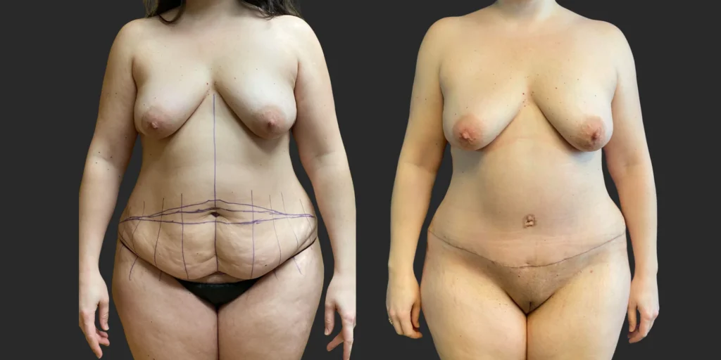 Abdominoplasty #007, before and after photo