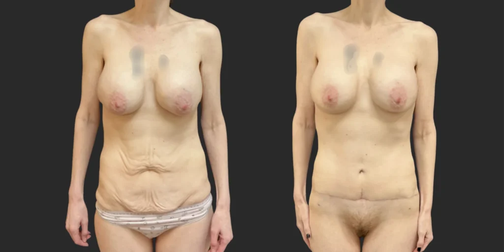 Abdominoplasty #008, before and after photo