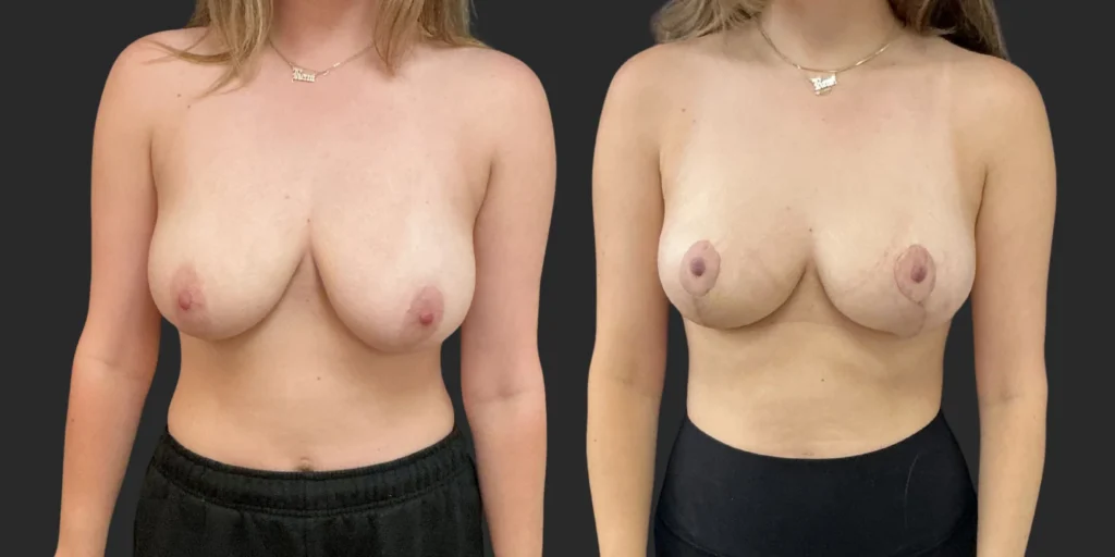 Bilateral Breast Reduction  #010, before and after photo