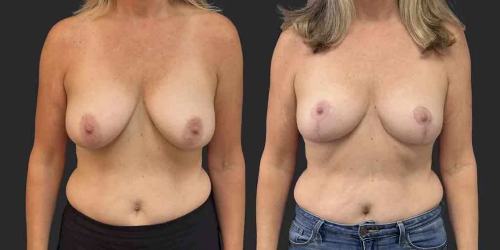 Bilateral Breast Reduction  #011, before and after photo