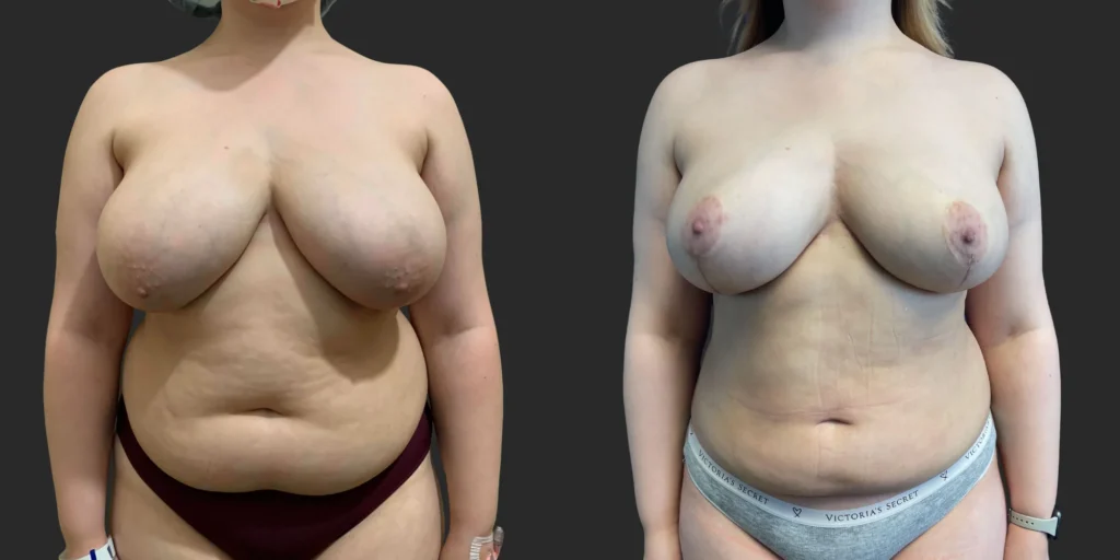 Breast Reduction  #012, before and after photo