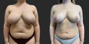 Breast Reduction  #012, before and after photo