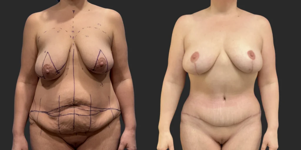 Bilateral Mastopexy, Abdominoplasty and Liposuction of Hips, Waist and Back Bra Roll  #007, before and after photo