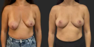 Mastopexy  #027, before and after photo