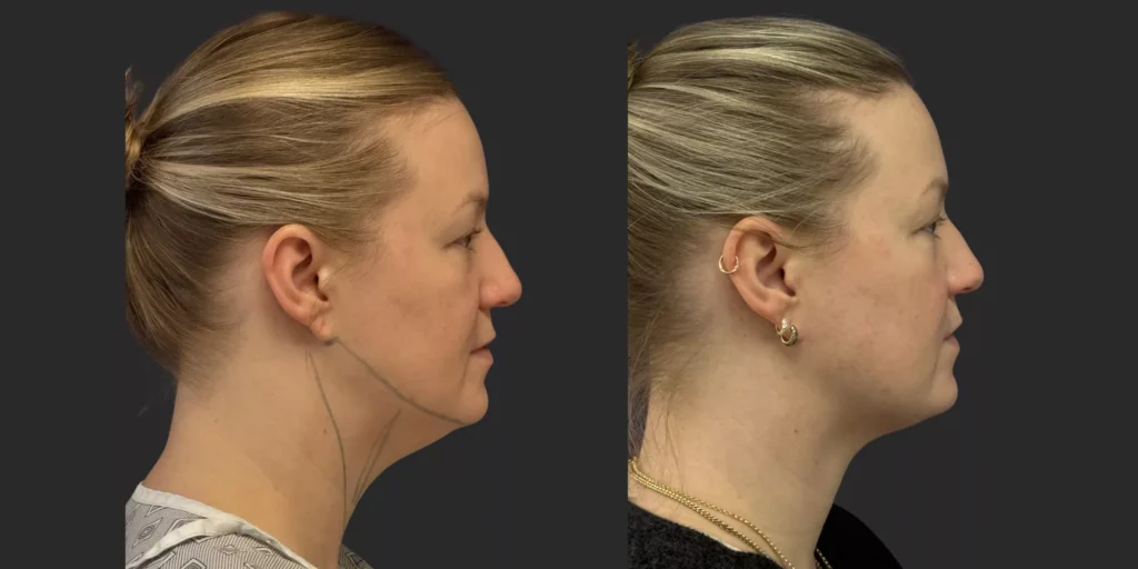 Chin Liposuction #004, before and after photo, view 2