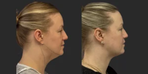 Chin Liposuction #004, before and after photo, view 2