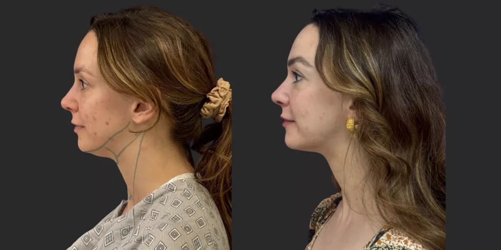 Chin Liposuction #005, before and after photo, view 2