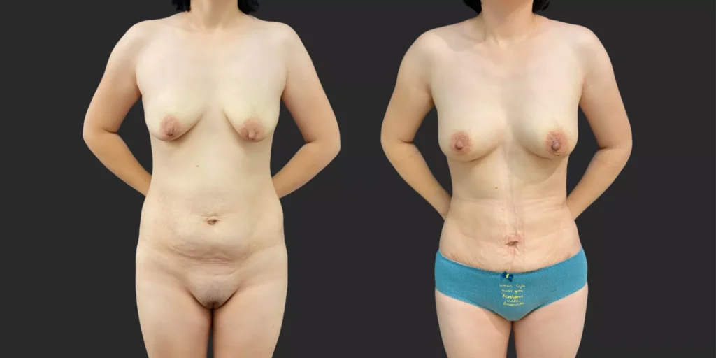 360 LBA #032, before and after photo