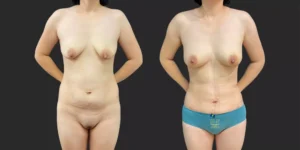 360 LBA #032, before and after photo