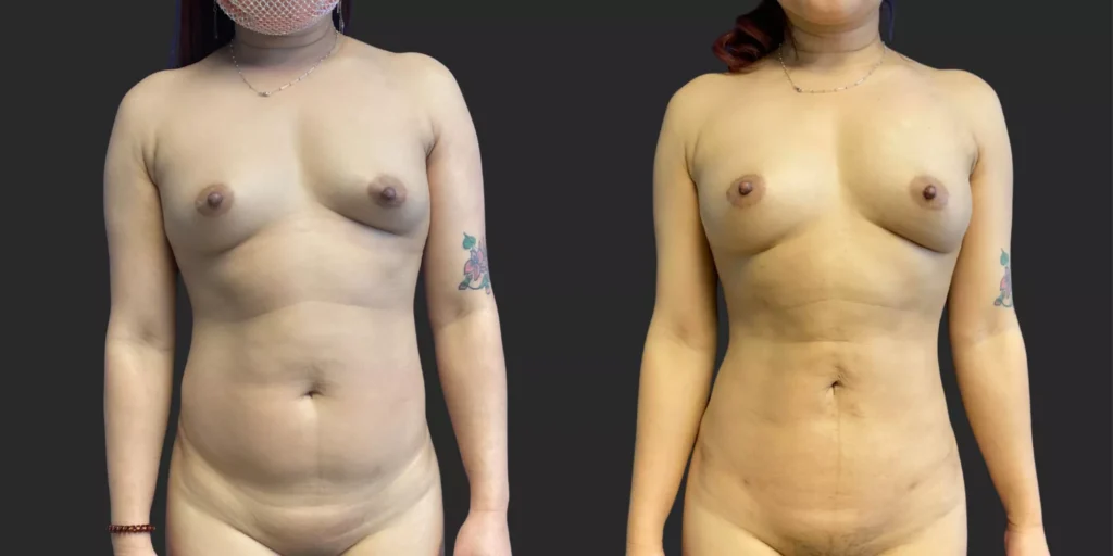 360 LBA plus armpits #033, before and after photo