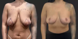 Bilateral Mastopexy  #001, before and after photo
