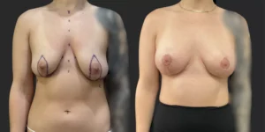 Bilateral Mastopexy  #003, before and after photo