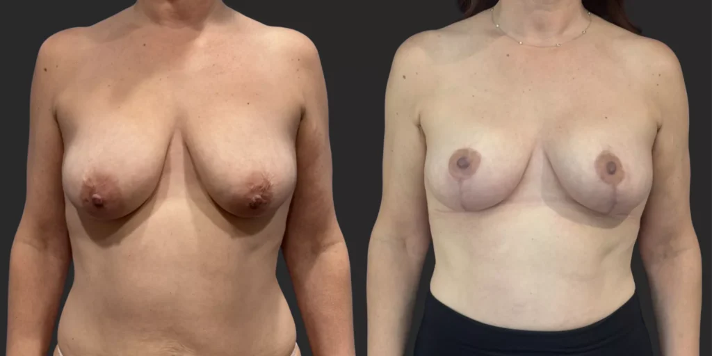 Bilateral Mastopexy  #002, before and after photo