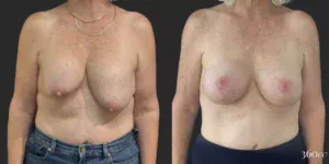 Bilateral Implant Exchange and Bilateral Mastopexy  #005, before and after photo