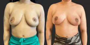 Bilateral Mastopexy  #018, before and after photo