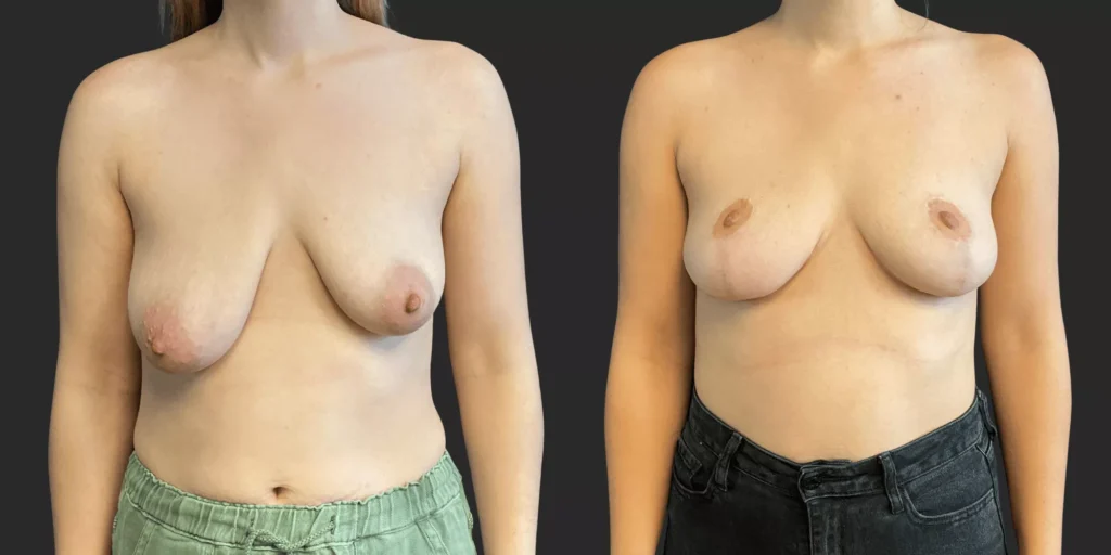 Bilateral Mastopexy  #015, before and after photo