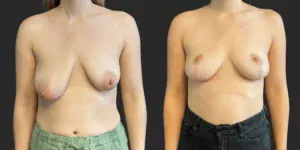 Bilateral Mastopexy  #015, before and after photo