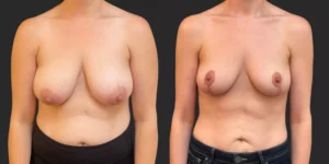 Bilateral Mastopexy  #012, before and after photo
