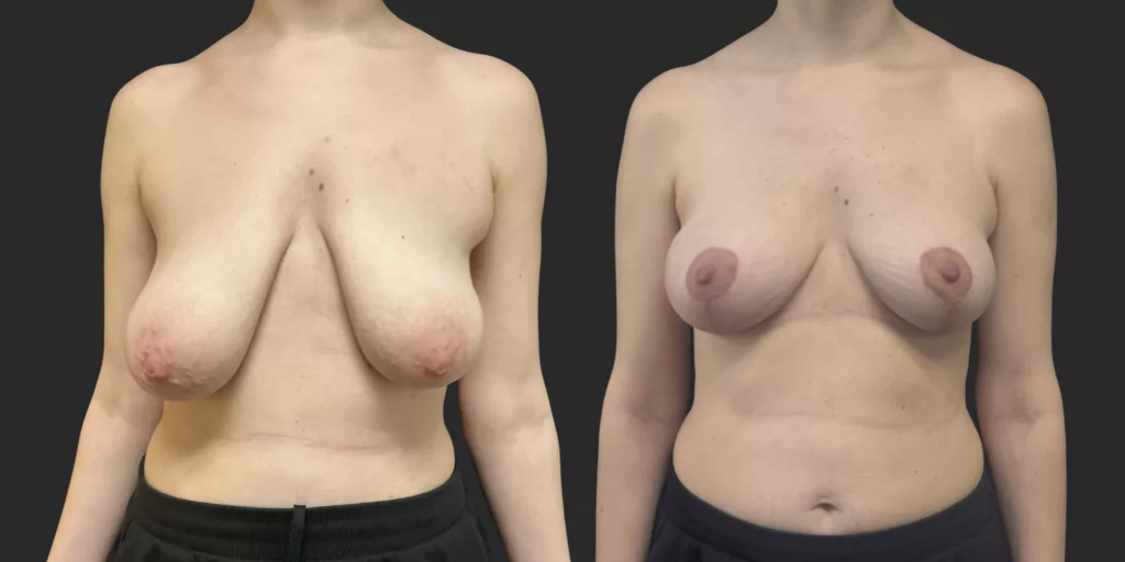 Bilateral Mastopexy  #008, before and after photo