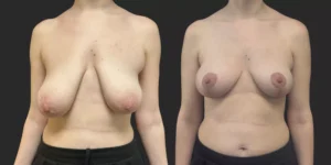 Bilateral Mastopexy  #008, before and after photo
