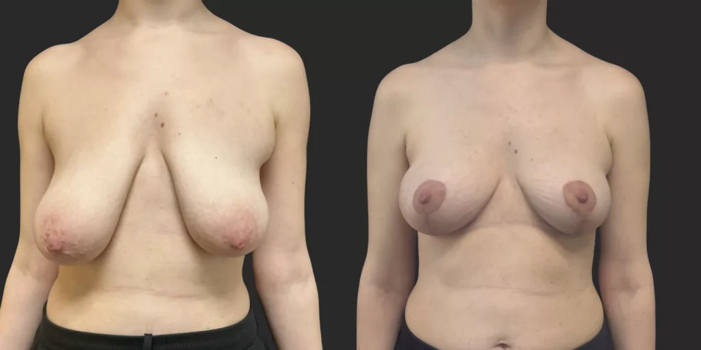 Bilateral Mastopexy  #006, before and after photo