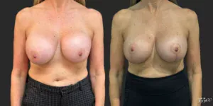 Bilateral Mastopexy and Bilateral Implant Exchange  #011, before and after photo