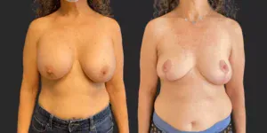 Bilateral Breast Implant Removal + Mastopexy #020, before and after photo