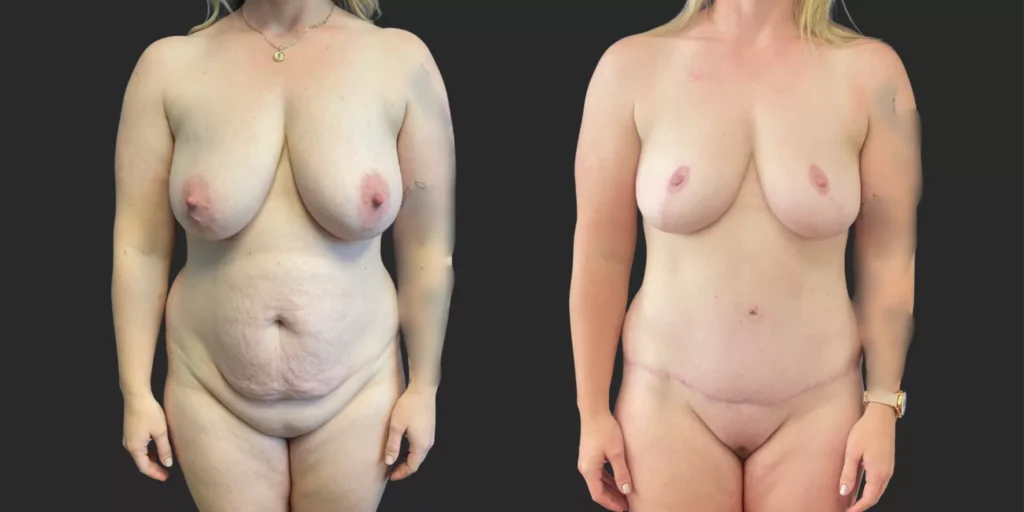 Abdominoplasty with Lipo of Hips/Waist and Bilateral Mastopexy  #017, before and after photo