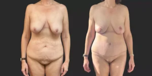 Abdominoplasty with Bilateral Mastopexy  #009, before and after photo